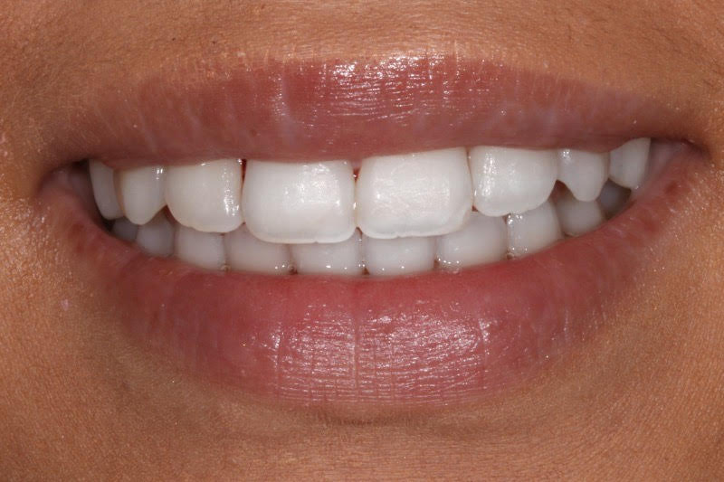 Fixed braces by Dr Sheraz Aleem