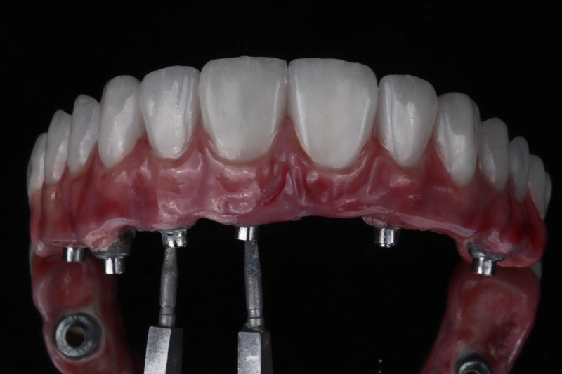 The highest quality same day full arch and mouth restoration