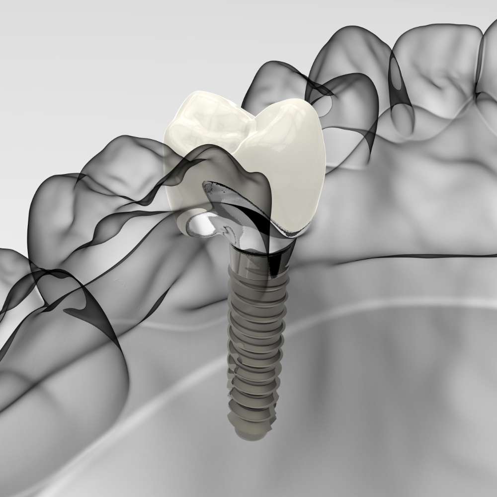 Same day dental implants at The Knightsbridge Clinic