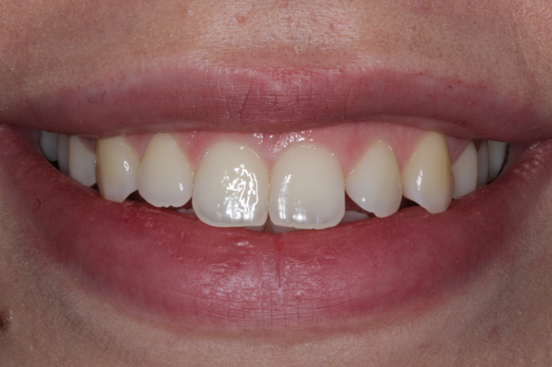 Teeth before Invisalign