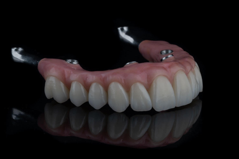 Pain free same day full mouth implants