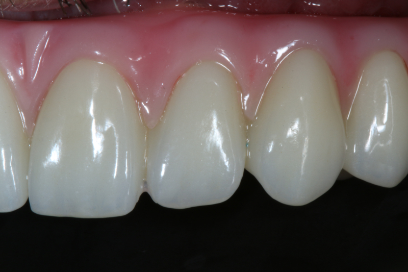 Missing teeth from Gum disease treatment